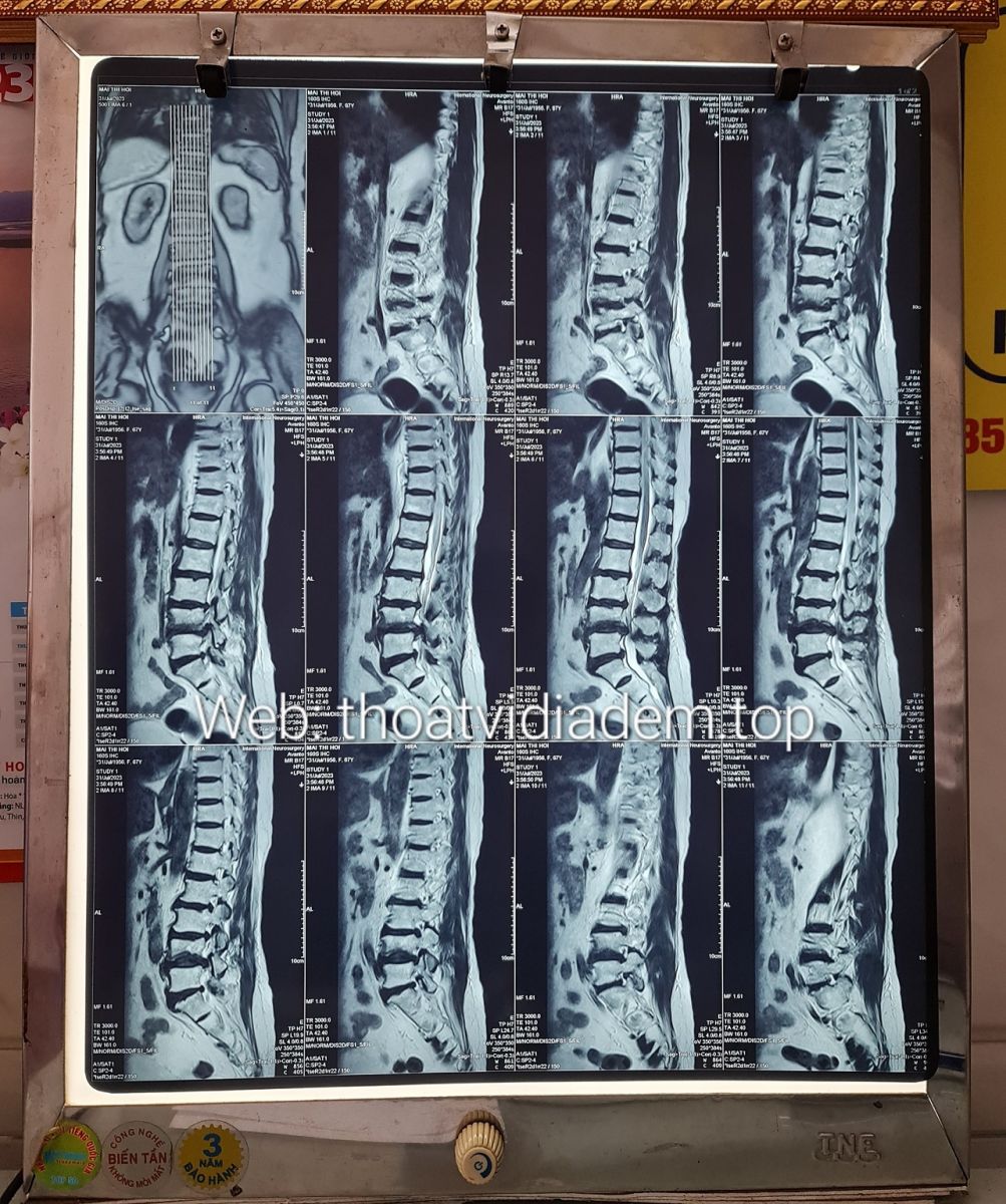 Hình ảnh thoát vị đĩa đệm L4 L5